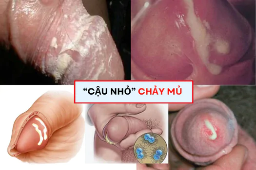 cau-nho-bi-chay-dich-mu-cach-dieu-tri-don-gian-1173