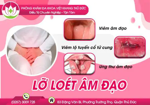 canh-bao-trieu-chung-lo-loet-am-dao-ca-nam-va-nu-357