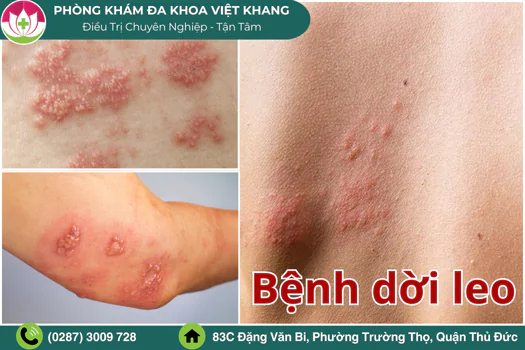benh-doi-leo-la-gi-nguyen-nhan-va-cach-nhan-biet-benh-1883