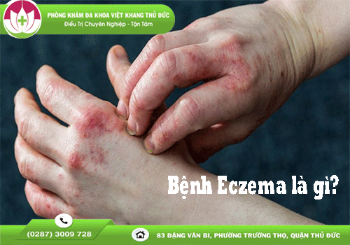 eczema-la-benh-gi-nhung-thong-tin-quan-trong-ban-nen-biet-1894
