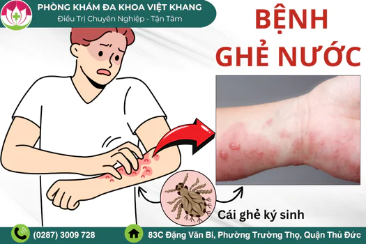 benh-ghe-nuoc-la-gi-chia-se-cach-dieu-tri-dung-tu-chuyen-gia-1774