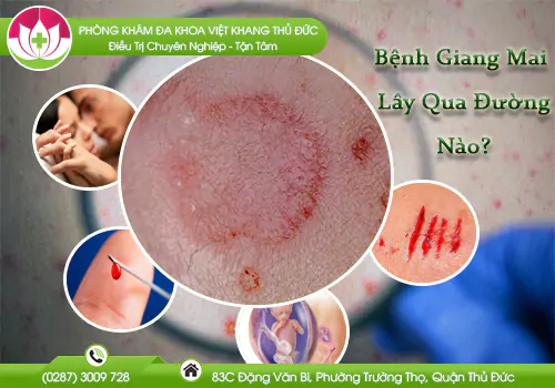 benh-giang-mai-lay-qua-duong-nao-1036