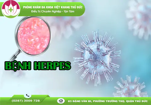 benh-herpes-can-benh-pho-bien-nhung-it-ai-hieu-ro-1856