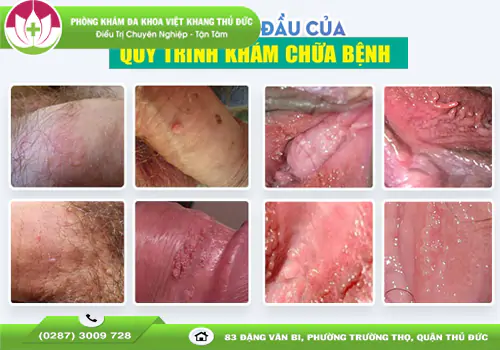 benh-sui-mao-ga-nhe-nhan-biet-som-de-dieu-tri-kip-thoi-2029