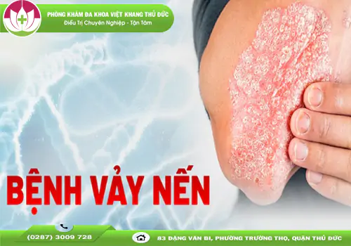 benh-vay-nen-la-gi-nhung-dieu-can-biet-de-kiem-soat-benh-hieu-qua-1787