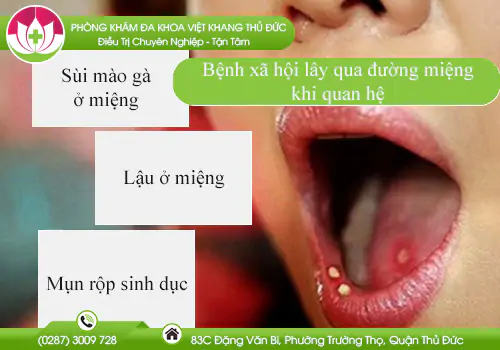 benh-xa-hoi-lay-qua-duong-mieng-khi-quan-he-747