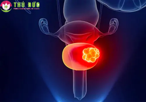 Bị đau bàng quang đó cũng là dấu hiệu điển hình của bệnh ung thư bàng quang
