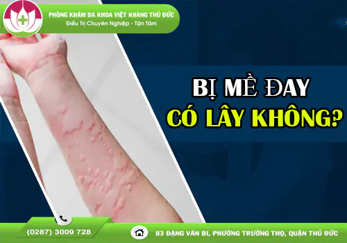 bi-me-day-co-lay-khong-hieu-dung-de-phong-ngua-hieu-qua-2089