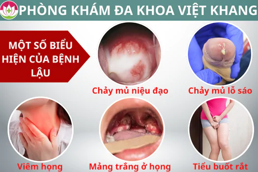 nhan-biet-dau-hieu-mac-benh-lau-can-lam-gi-khi-phat-hien-1290