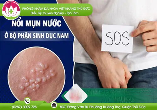 bo-phan-sinh-duc-nam-noi-mun-nuoc-783