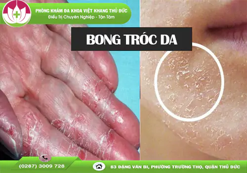 bong-troc-da-do-dau-va-cach-khac-phuc-hieu-qua-1919