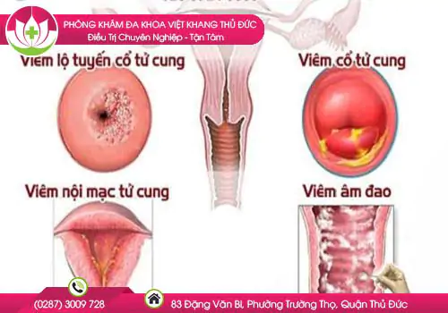 cac-benh-phu-khoa-thuong-gap-o-chi-em-663