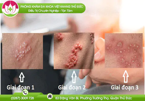 cac-giai-doan-cua-benh-lau-704
