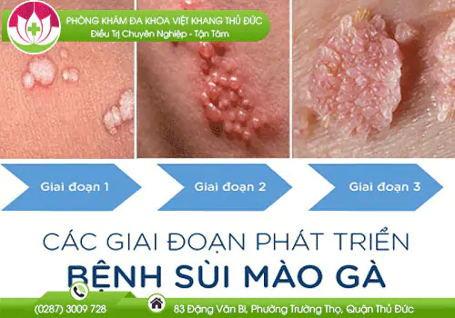 cac-giai-doan-cua-benh-ly-sui-mao-ga-709