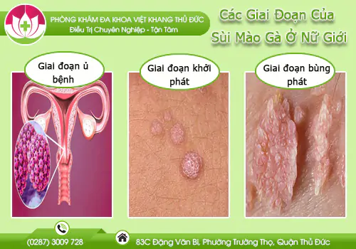 cac-giai-doan-cua-sui-mao-ga-o-nu-gioi-va-cach-dieu-tri-1009