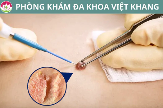 phuong-phap-dieu-tri-sui-mao-ga-ala-pdt-tien-tien-hien-nay-1264