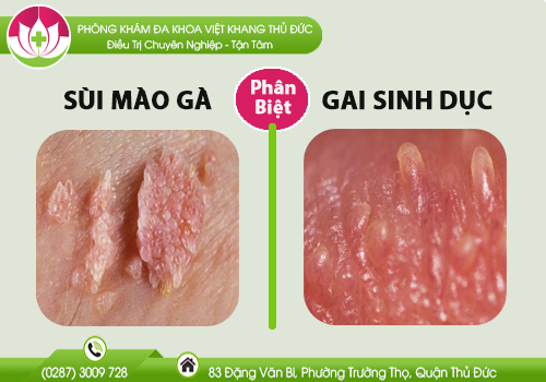 cach-phan-biet-sui-mao-ga-va-gai-sinh-duc-nhu-the-nao-754