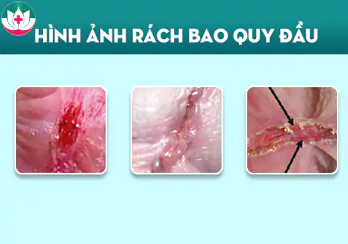 Nam giới bị rách bao quy đầu nếu không xử lý sẽ gây nhiều tác hại