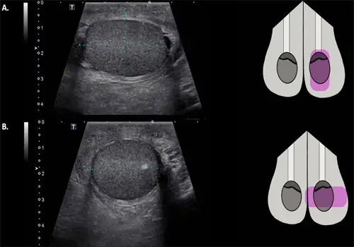Siêu âm một trong những biện pháp kiểm tran, chẩn đoán ung thư tinh hoàn