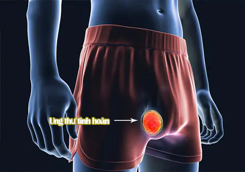 Hình ảnh ung thư tinh hoàn ở nam giới