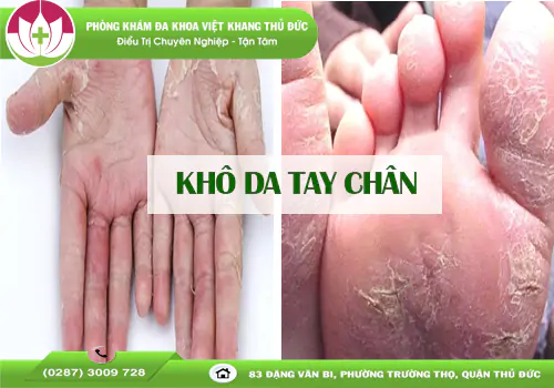 canh-bao-kho-da-tay-chan-dau-hieu-benh-ly-dung-chu-quan-1873