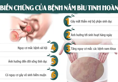Tác hại nấm tinh hoàn khi không khám điều trị sớm gây ra