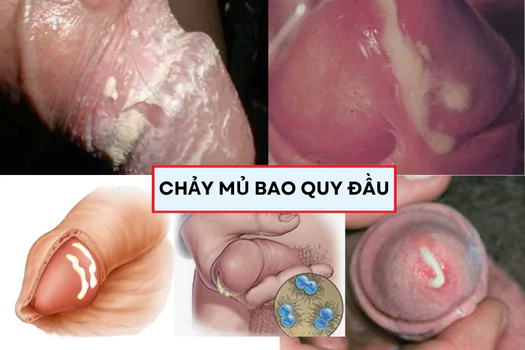 chay-mu-bao-quy-dau-khong-nen-chu-quan-khi-dieu-tri-1179