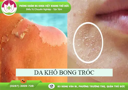 da-kho-bong-troc-la-dau-hieu-gi-va-cach-tri-an-toan-hieu-qua-2083