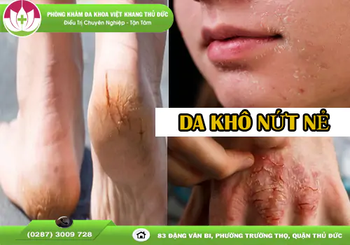 da-kho-nut-ne-nguyen-nhan-va-cach-khac-phuc-hieu-qua-2081
