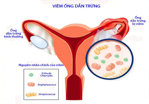 Đau bụng dưới bên phải đó còn là biểu hiện của bệnh viêm ống dẫn trứng