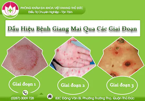 dau-hieu-benh-giang-mai-qua-cac-giai-doan-bieu-hien-nhu-the-nao-1037