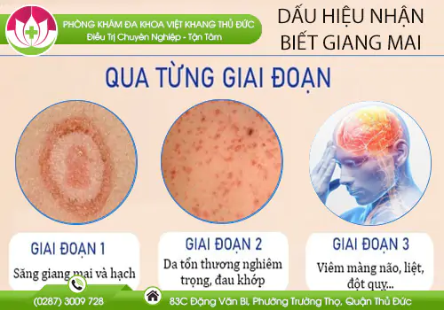 dau-hieu-nhan-biet-benh-giang-mai-555