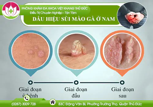 dau-hieu-sui-mao-ga-o-nam-812