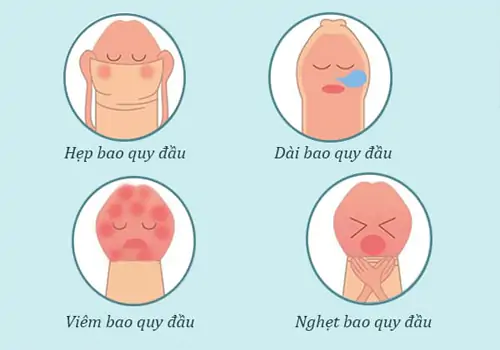 Bệnh bao quy đầu cũng thuộc các bệnh lý nam khoa nguy hiểm thường gặp
