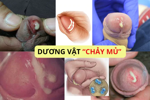 duong-vat-chay-mu-co-sao-khong-canh-bao-benh-ly-tiem-an-1171