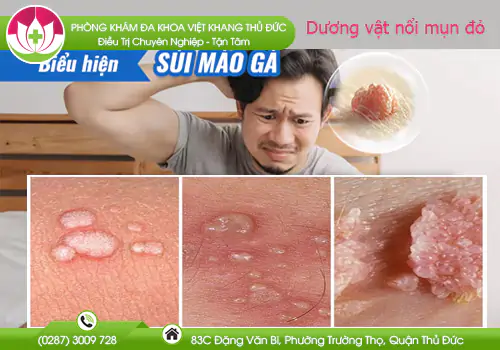 duong-vat-noi-mun-do-la-dau-hieu-cua-benh-gi-712