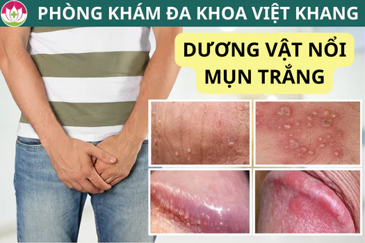 duong-vat-noi-mun-trang-la-bi-gi-cach-loai-bo-mun-nhanh-chong-1276