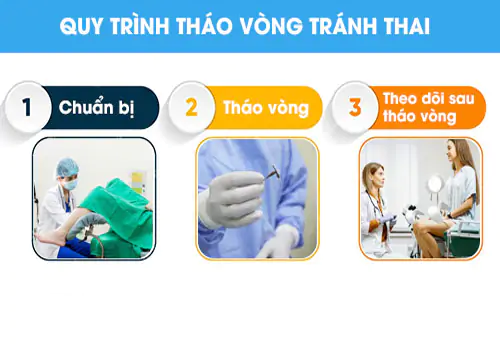 Quy trình thực hiện tháo vòng an toàn, đúng chuẩn
