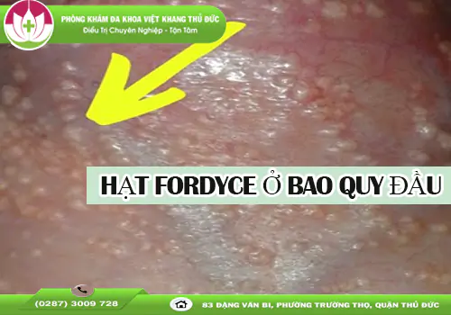 hat-fordyce-o-bao-quy-dau-la-gi-khi-nao-can-dieu-tri-2072