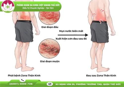 hieu-dung-ve-benh-zona-than-kinh-nguy-hai-va-cach-tri-an-toan-1784