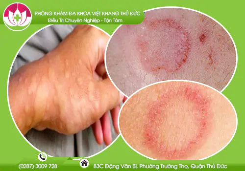 hinh-anh-benh-giang-mai-o-nam-va-nu-1035