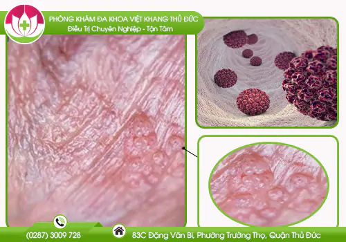 nguyen-nhan-va-hinh-anh-sui-mao-ga-o-duong-vat-893