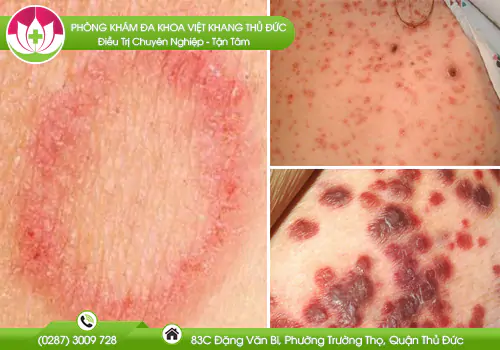hinh-anh-vet-loet-giang-mai-nhu-the-nao-1048