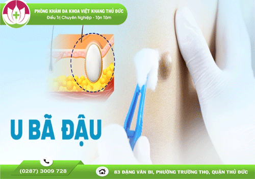 chi-tiet-quy-trinh-va-chi-phi-dieu-tri-mo-u-ba-dau-1777