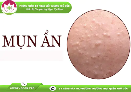 mun-an-la-gi-nguyen-nhan-dau-hieu-va-cach-ngan-ngua-1888