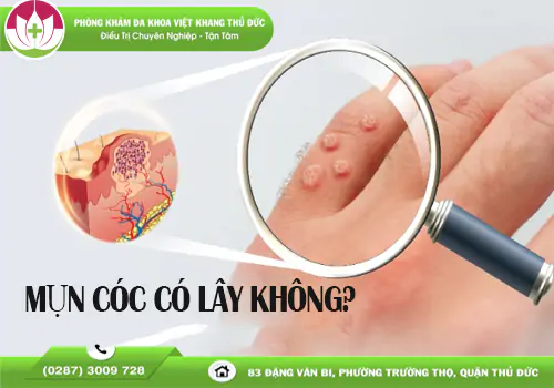 mun-coc-co-lay-khong-canh-bao-nhung-con-duong-de-lay-nhiem-2048
