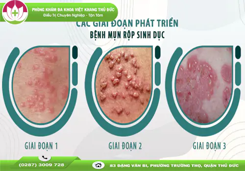 mun-coc-giai-doan-dau-co-nguy-hiem-khong-cach-nhan-biet-va-dieu-tri-1666