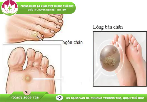 mun-coc-o-chan-co-nguy-hiem-khong-khi-nao-can-di-kham-2149