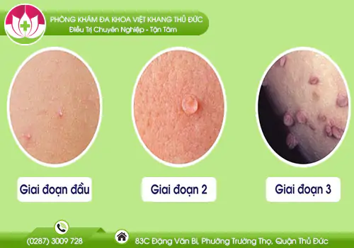 mun-coc-sinh-duc-la-benh-gi-nguyen-nhan-va-cach-dieu-tri-hieu-qua-894