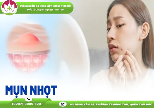 Mụn nhọt: Những thông tin cần biết